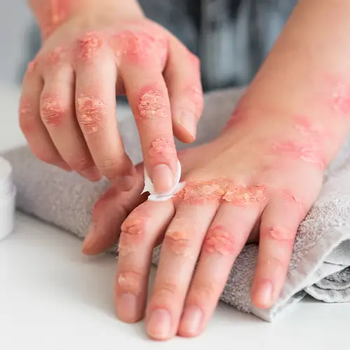 A Complete Guide to Identifying and Treating Skin Rashes