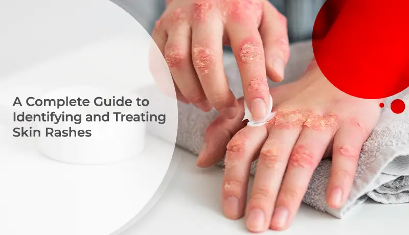 A Complete Guide to Identifying and Treating Skin Rashes
