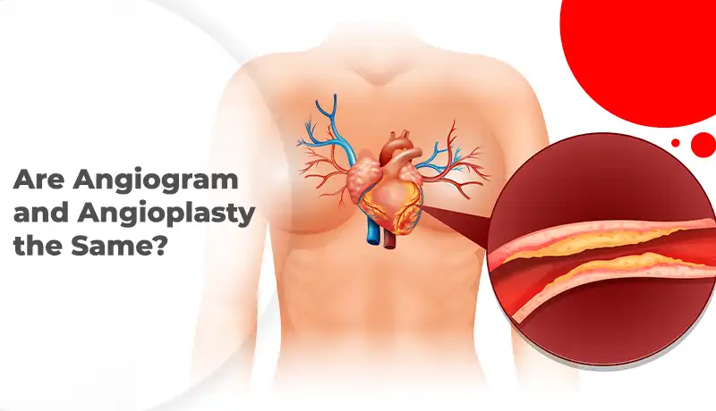 Are Angiogram and Angioplasty the Same?
