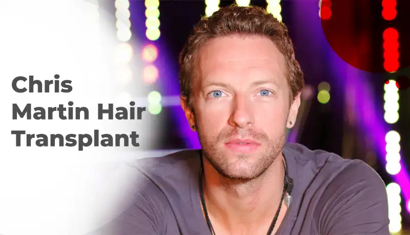 Chris Martin Hair Transplant