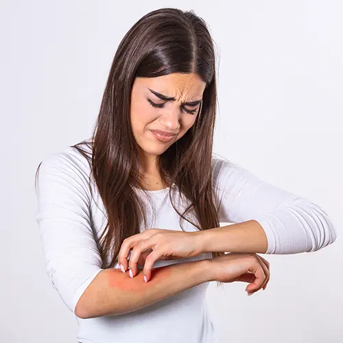 Eczema: Causes, Symptoms, and Effective Treatments