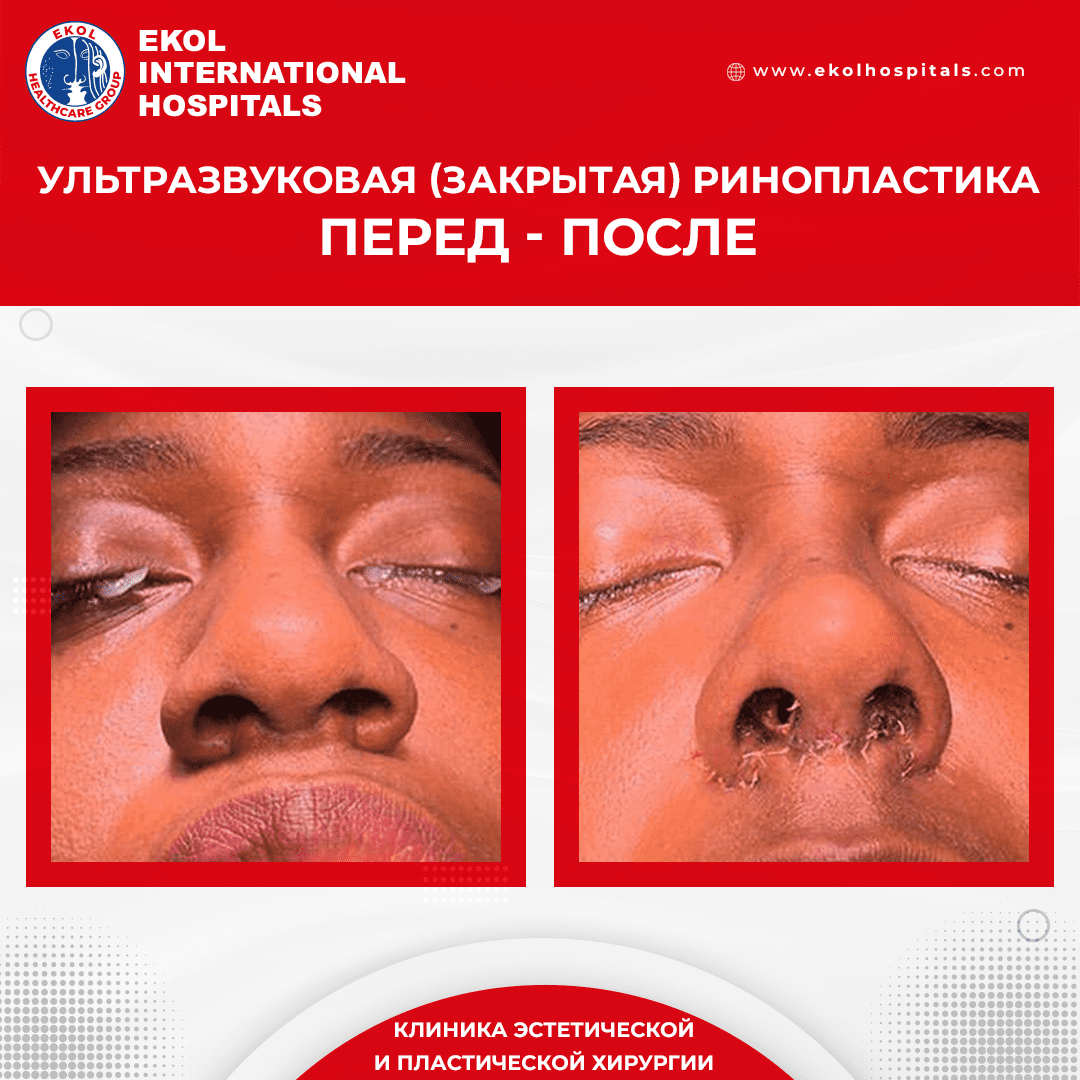 Gynecomasty Liposuction Operations In Ekol Hospitals Esthetic Gynecomasty Liposuction Operations In Ekol Hospitals Esthetic