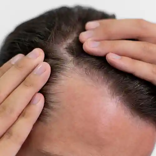 Hair Transplant for Ethnic Hair: What to Know