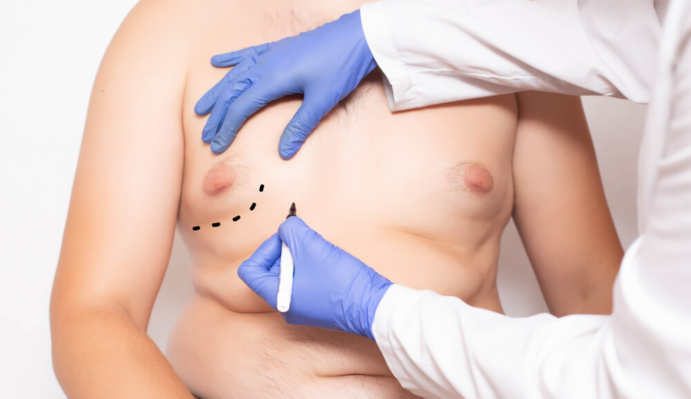 جراحة الثّدي عند الرجال