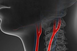 Neck Carotid Artery (Carotid Artery) Stenosis