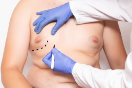 جراحة الثّدي عند الرجال