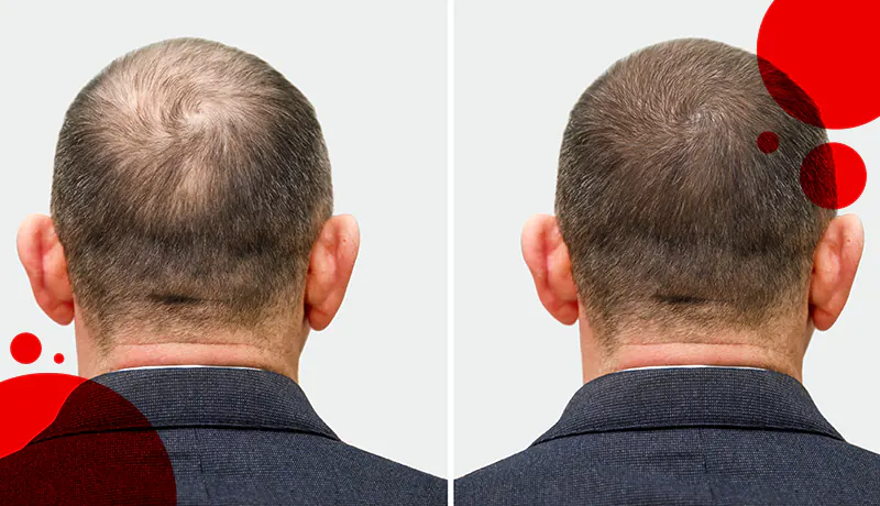 Affordable & High-quality Hair Transplant in Turkey - Get Natural-looking  Results